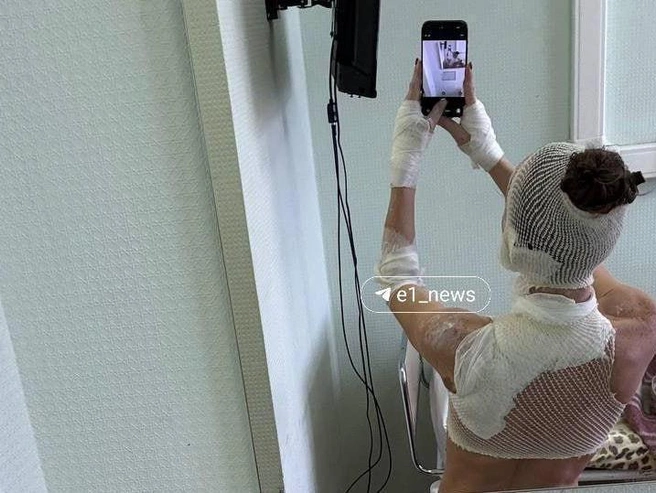 В результате нападения у женщины возникли ожоги рук, лица, плеч и шеи. | Источник: читатель E1.RU