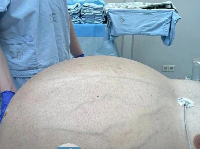 После 50 лет живот пациента вырос настолько, что это стало причинять серьёзные затруднения. | Источник: Минздрав Свердловской области