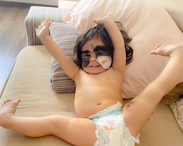 Фото американской девочки с «пятном Бэтмена» после операции в России