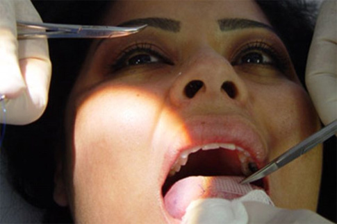 Рот зашью: заплатка на язык спасет от лишнего веса