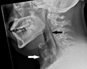 Чихнул «в себя» и порвал горло: уникальный случай в медицине