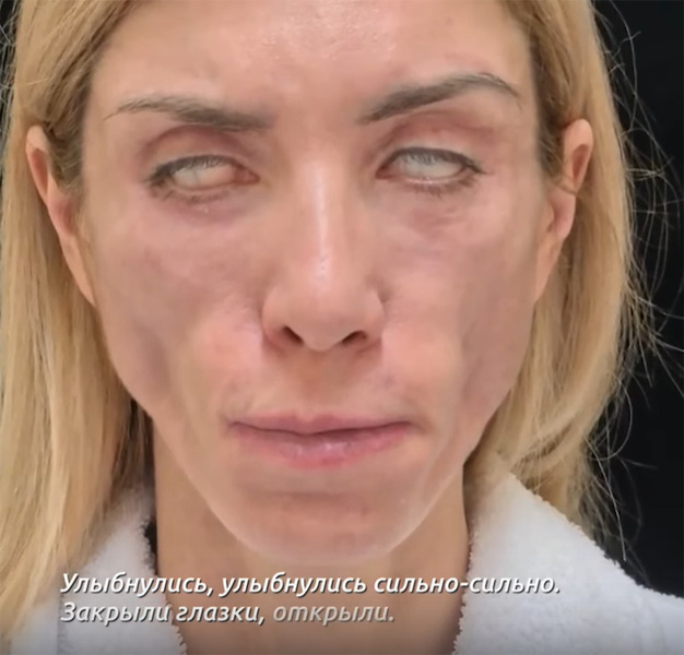 «Спасает только маска»: «Вице-Миссис Россия International 2020» изуродовали после пластики