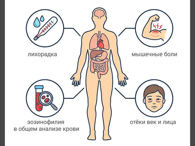 Тяжёлое течение трихинеллёза способно вызывать поражения нервной системы | Источник: Юрий Орлов / Городские порталы