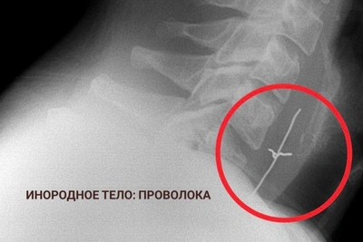 Pyatigorsk Doctors Remove Batteries, Crowns from Patients