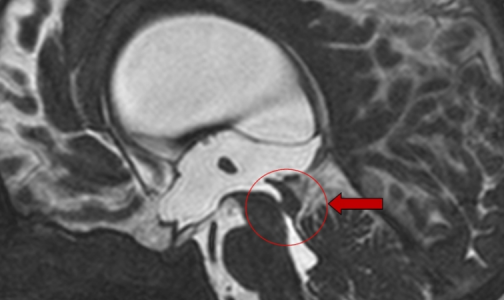 Грудной малыш с огромной головой перенес непростую операцию, избавившую от гидроцефалии
