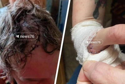 Yaroslavl pensioner shows injuries after scissors attack