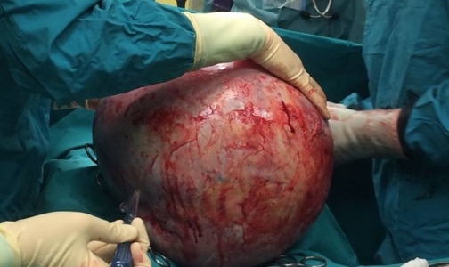 Хирурги сохранили москвичке с гигантской опухолью яичника возможность родить