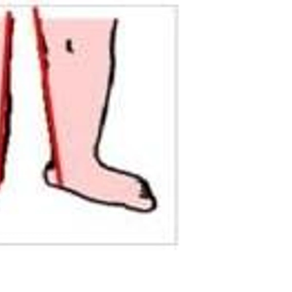 Синдром Прадера-Вилли фото | Источник: International Journal of Pediatric Endocrinology