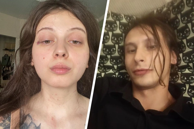 Валерия часто ходила с синяками на лице, которые ей ставил возлюбленный (на фото справа) | Источник: Валерия Васильева