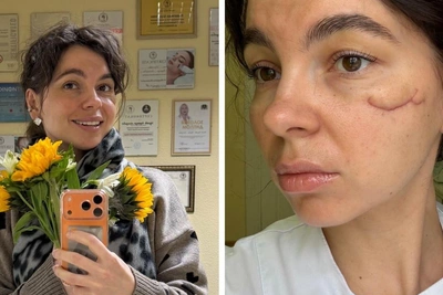 Королева красоты о восстановлении лица после нападения