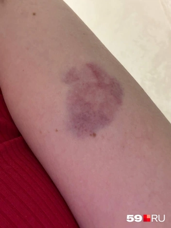 После нападения у девушки остался синяк | Источник: Анна Кричфалушая