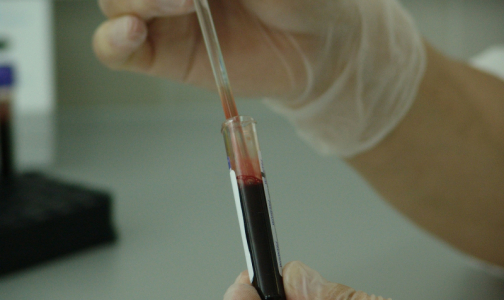 Ученые: Житель Бразилии излечился от ВИЧ без трансплантации стволовых клеток