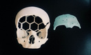 В Петербурге подростку создали новый череп с помощью трансплантата