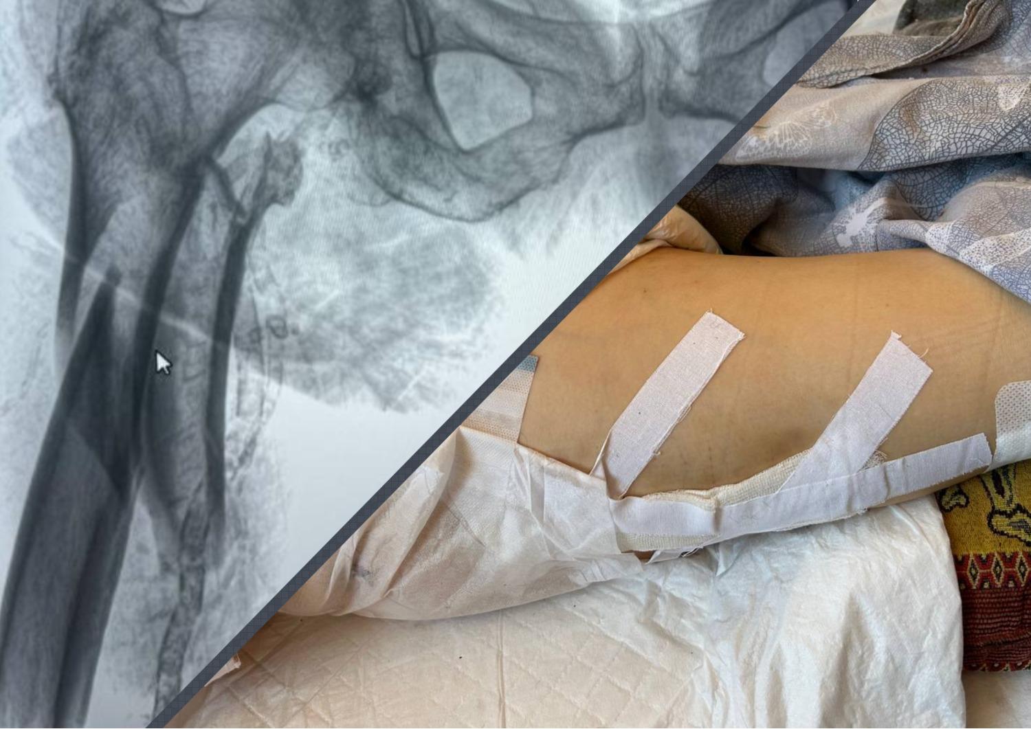 «Кость была раздроблена как вилка»: в Самаре пенсионерка скончалась после травмы в «Пятерочке» — ее зажало в дверях