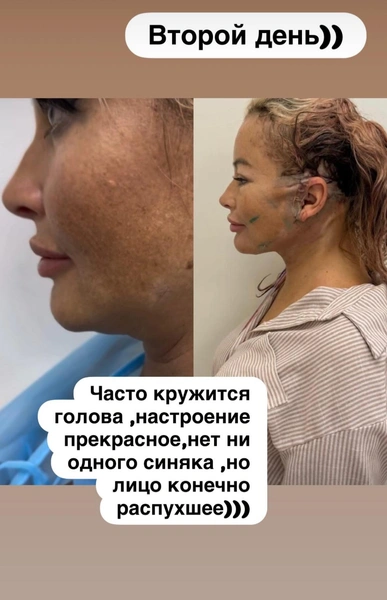 49-летняя ведущая решила омолодиться, подтянув свои шею и подбородок