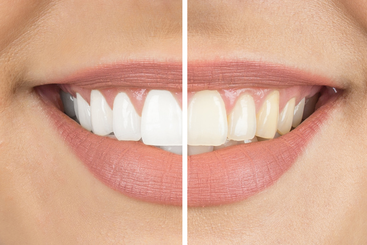 «Полное разрушение»: эксперт объяснил, чем опасны отбеливающие полоски для зубов