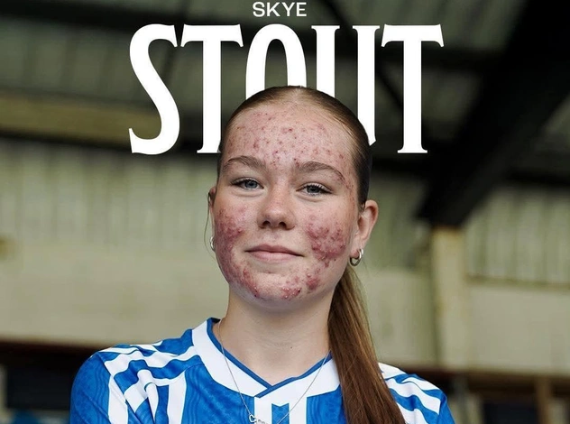 В Шотландии 16-летнюю футболистку затравили из-за акне. Ее поддержали известные клубы и игроки