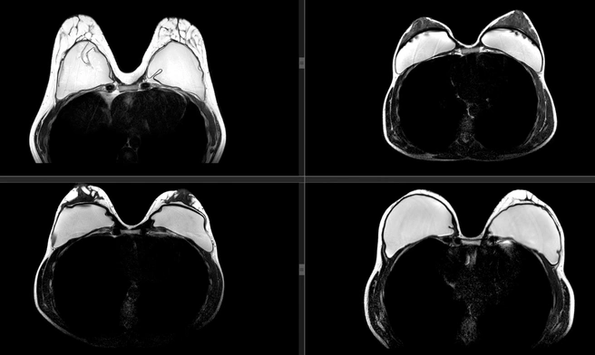 Магнитно-резонансные томограммы с целью оценки состояния имплантов | Источник: «МРТ технологии» МТЦ СО РАН
