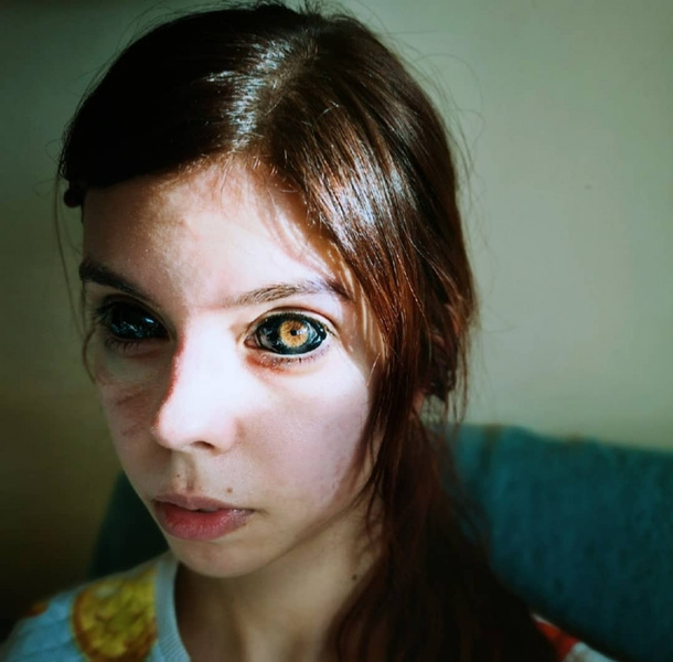 Польская модель окрасила белки глаз, почти ослепла и теперь судится с тату-мастером