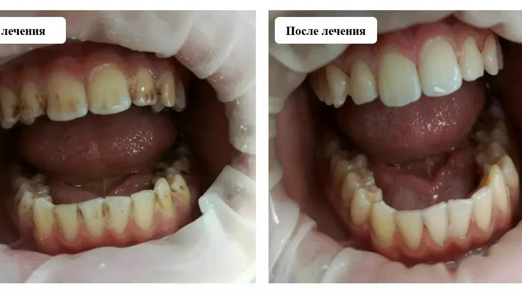 У школьника почернели зубы из-за того, что он пил чай и колу. Покажите это фото своим детям