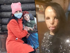 «Бабушка показывала меня за деньги»: как живет молодая россиянка с полностью обгоревшим лицом