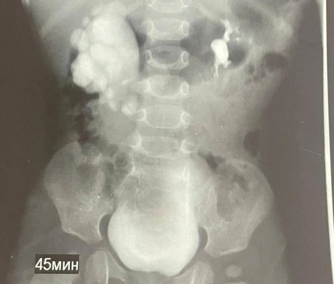 Слева — здоровая лоханка, справа — картина гидронефроза | Источник: Городская клиническая больница скорой медицинской помощи Ставрополя / Telegram