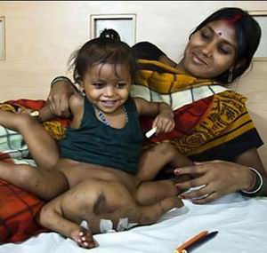 Индийской девочке-богине удалят лишние ноги и руки