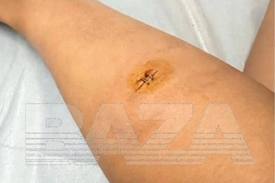 Kazan tourist hospitalized on Bali after beetle bite