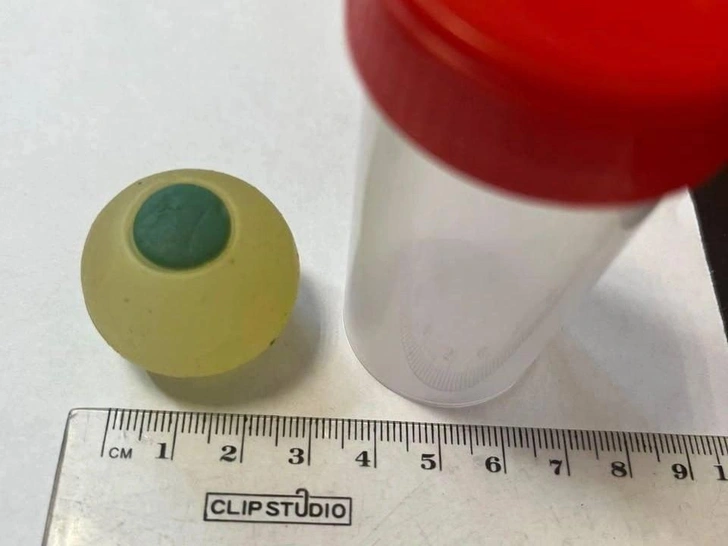 Челябинские хирурги достали из кишечника 9-летнего мальчика силиконовый глаз | Источник: телеграм-канал Министерства здравоохранения Челябинской области