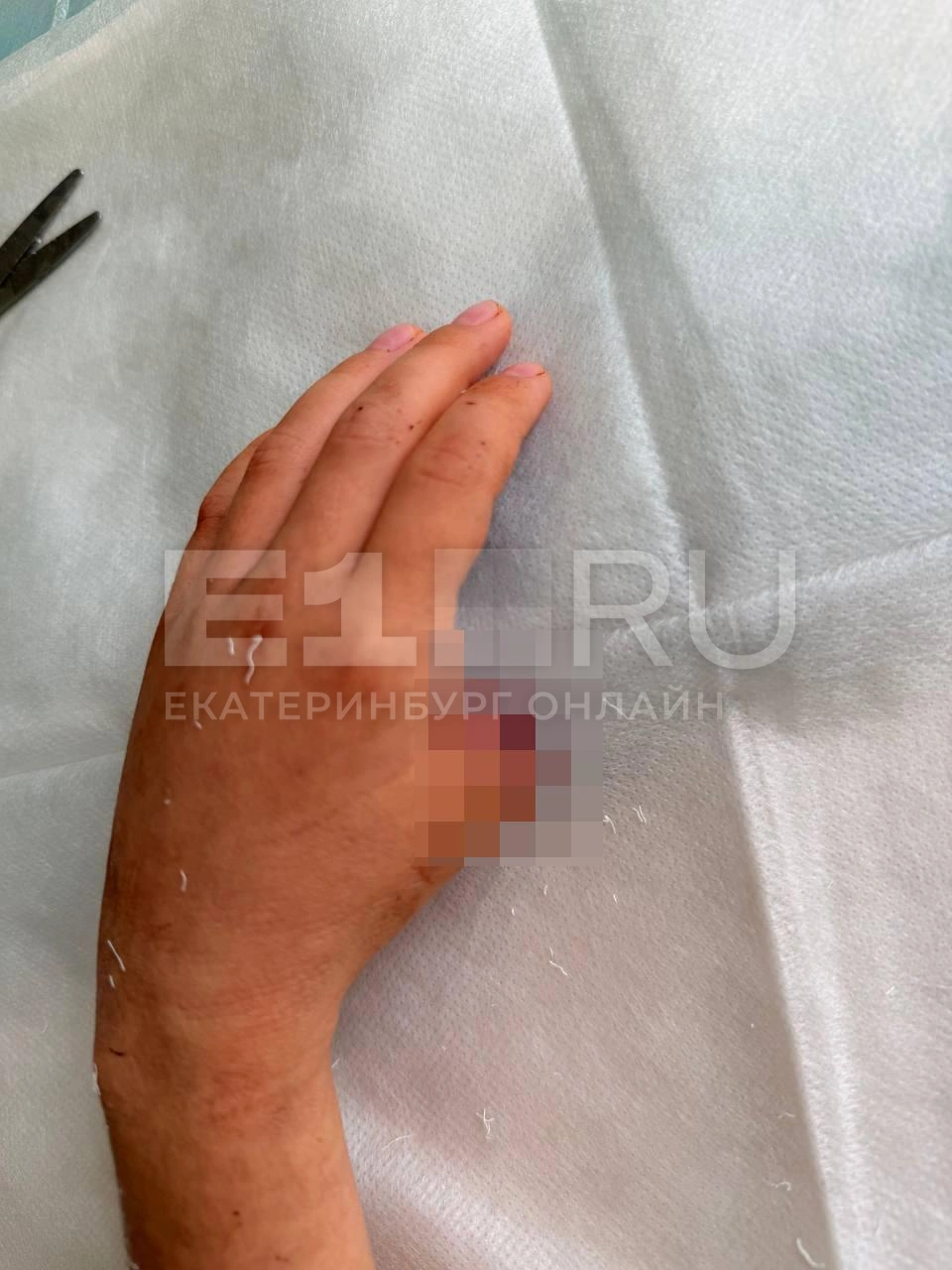 Девятилетняя девочка осталась без большого пальца на левой руке | Источник: читательница E1.RU