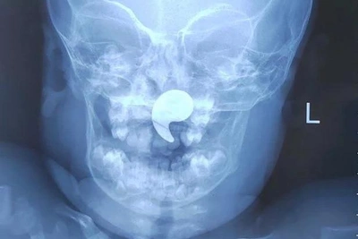 В Воронеже девочке удалили магнит из носоглотки