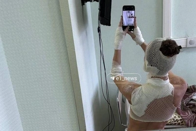 Acid Attack Survivor Recounts Recovery in Yekaterinburg