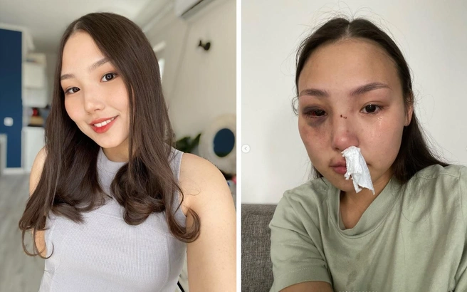 Девушка до избиения и после | Источник: vunswet / Instagram (экстремистская организация, деятельность запрещена в РФ)