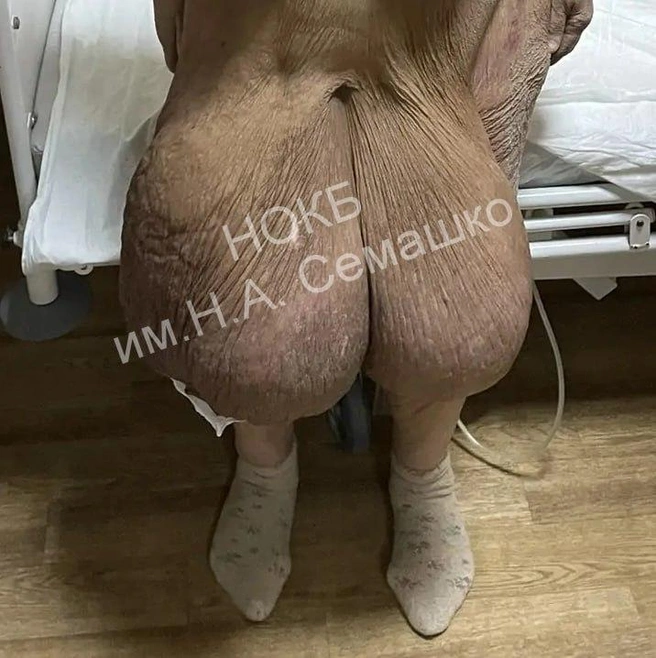 Это последствия гигантской лимфедемы, которую успешно удалили у нижегородки | Источник: presseco / T.me