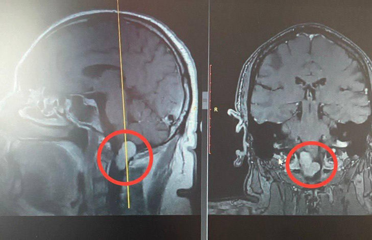 Звон и жужжание в ухе у жителя Подмосковья оказались симптомом опухоли мозга