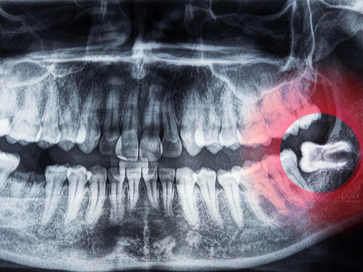 10 фактов о зубах мудрости, которые ты вряд ли знала