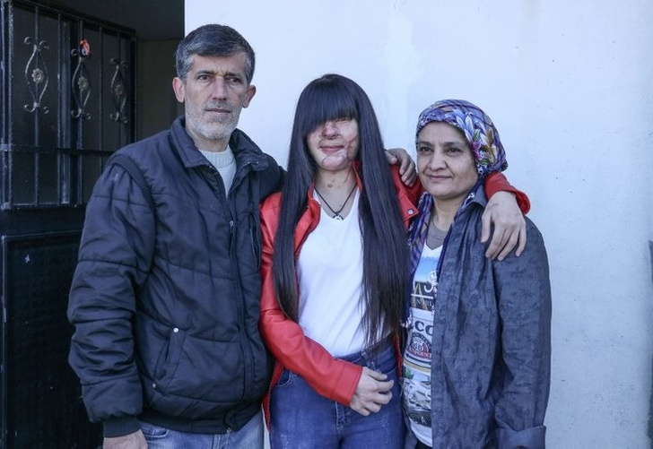 От ненависти до любви: турчанка вышла замуж за парня, облившего ее кислотой