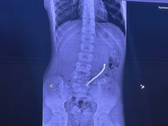 Редкое заболевание. Иркутские врачи спасли 8-летнего мальчика, проглотившего 16 магнитных шариков | Источник: Telegram-канал главного врача Иркутской областной детской больницы Юрия Козлова