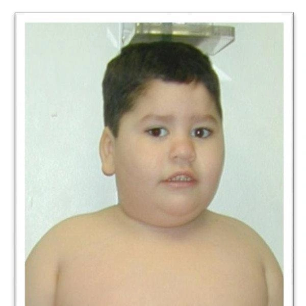 Синдром Прадера-Вилли фото | Источник: International Journal of Pediatric Endocrinology