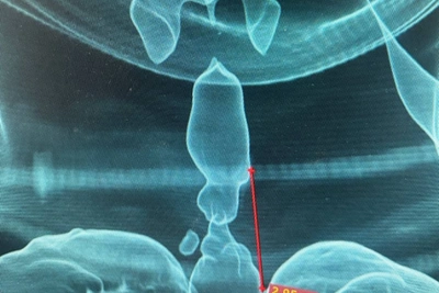 Хирурги Удмуртии восстановили дыхание после аварии