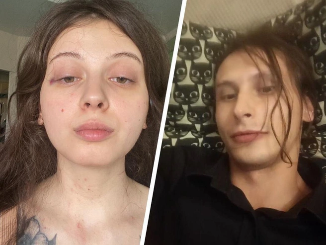 После избиений на теле Валерии регулярно оставались синяки | Источник: Валерия Васильева