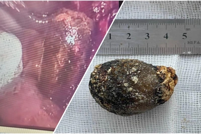 В Пятигорске удалили огромный камень, едва не стоивший пациентке жизни