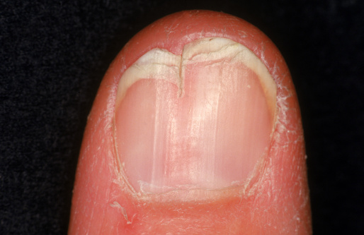 Причины и виды деформаций ногтя