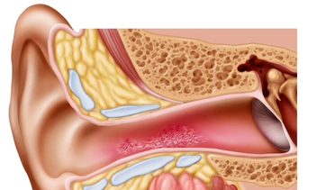 Лечение золотистого стафилококка в ушах