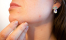Ковид на лицо: Дерматолог рассказал, как инфекция влияет на кожу