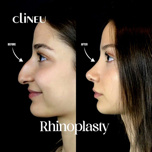 Невероятные преображение женщин до и после пластики носа: 10 фото