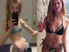 21-летняя девушка смогла побороть анорексию с помощью шоколада