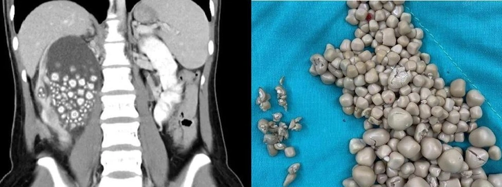 Врачи в Тайнане удалили 300 камней из почек девушки, которая несколько лет не пила воду