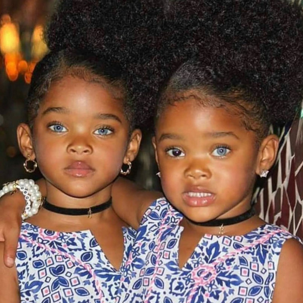 12-летние близняшки прославились из-за генетической мутации: фото