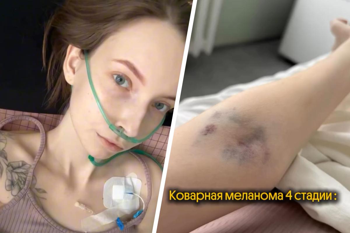 24-летняя пермячка спустя четыре года после удаления родинки узнала о меланоме четвертой стадии — ей срочно нужна кровь